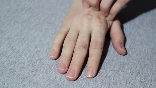Girl's hand with eczema and psoriasis strong itching