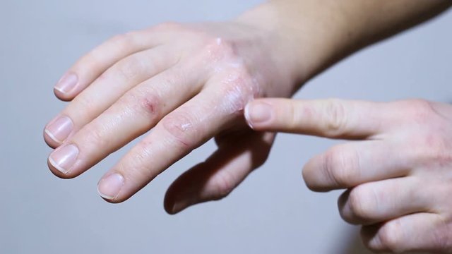 Girl rubs cream hand with eczema and psoriasis