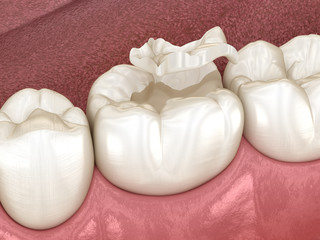 Fototapeta na wymiar Inlay ceramic crown fixation over tooth. Medically accurate 3D illustration of human teeth treatment