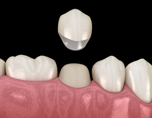 Preparated premolar tooth for dental crown placement. Medically accurate 3D illustration