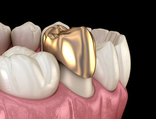 Golden crown premolar tooth assembly process. Medically accurate 3D illustration of human teeth...