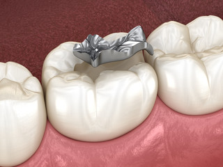 Inlay silver crown fixation over tooth. Medically accurate 3D illustration of human teeth treatment