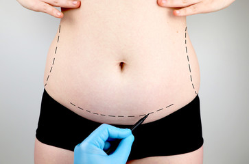 Abdominoplasty and torsoplasty: abdominal liposuction and removal of the apron. The patient at the reception at the plastic surgeon