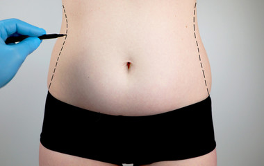 Abdominoplasty and torsoplasty: abdominal liposuction and removal of the apron. The patient at the...