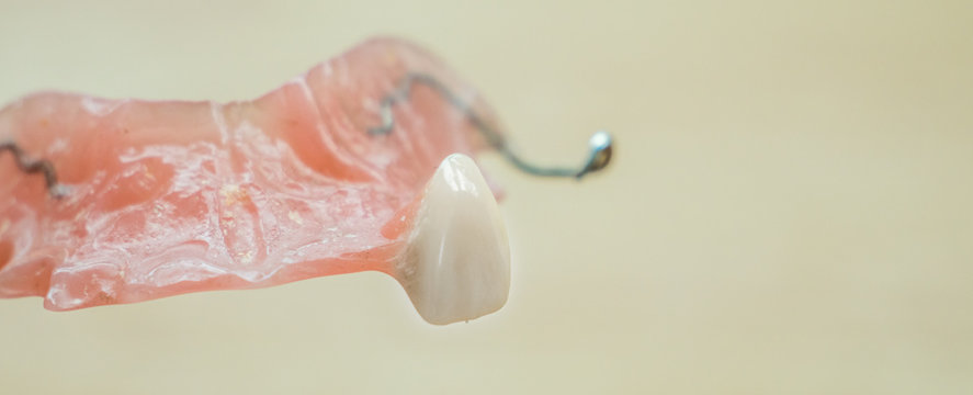 Zahnprothese mit einem Zahn