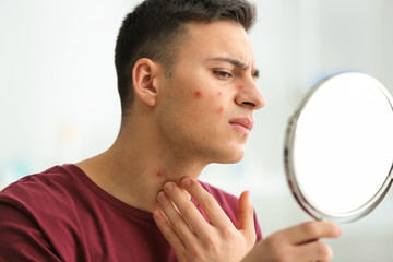 Portrait of young man with acne problem looking in mirror at home