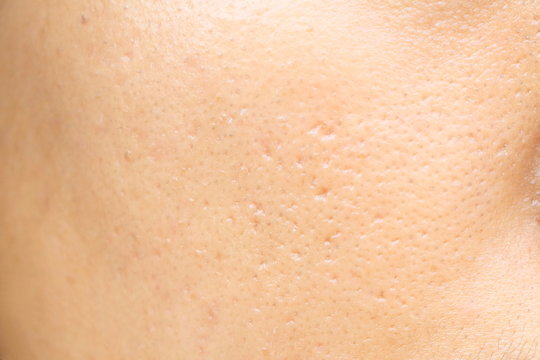 close up wide pores on oily face skin of asia woman