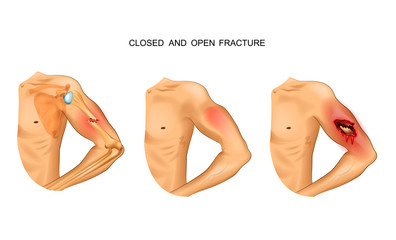 open and closed fracture