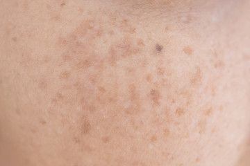 Fototapeta premium freckle on asian woman skin