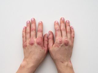 Psoriasis skin. Closeup of rash and scaling on the patient's skin. The concept of chronic disease treatment. Dermatological problems. Hard, horny and cracked skin in woman's hands. Dry skin. Isolated.