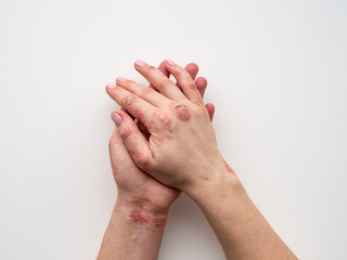 Psoriasis skin. Closeup of rash and scaling on the patient's skin. The concept of chronic disease treatment. Dermatological problems. Hard, horny and cracked skin in woman's hands. Dry skin. Isolated.