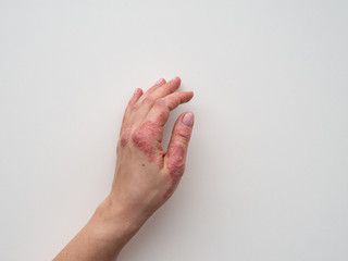 Psoriasis skin. Closeup of rash and scaling on the patient's skin. The concept of chronic disease treatment. Dermatological problems. Hard, horny and cracked skin in woman's hand. Dry skin. Isolated