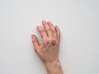 Psoriasis skin. Closeup of rash and scaling on the patient's skin. The concept of chronic disease...