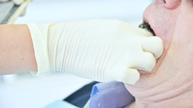 A close-up of a stomatologist removes from his mouth polymeric forms for a patient aged color to create a prosthesis. Dentistry in 4k