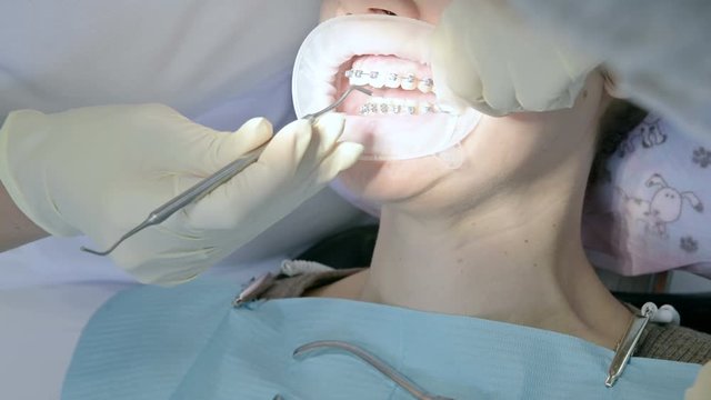 Close-up of dentist's hand in rubber gloves sets adult braces to an adult woman. Prevention braces in adulthood. Dentistry in 4k