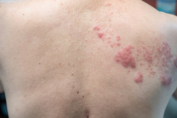 Shingles (Disease), Herpes zoster, varicella-zoster virus. skin rash and blisters