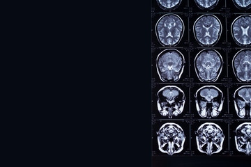 magnetic resonance imaging and X-ray film research results