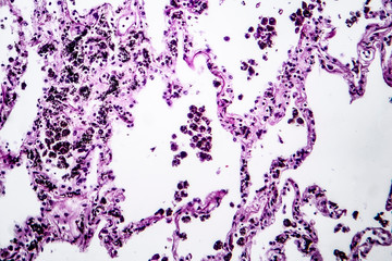 Histopathology of lung emphysema, light micrograph, photo under microscope showing enlargement of air spaces in lung tissue and destruction of alveolar septa