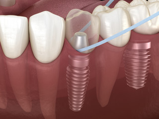 Implant tooth cleaning with dental floss. Medically accurate 3D illustration