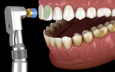 Teeth polishing procedure with professional brush and gel. Medically accurate 3D illustration