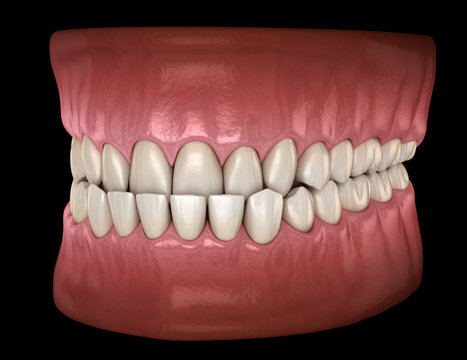 Underbite dental occlusion ( Malocclusion of teeth ). Medically accurate tooth 3D illustration