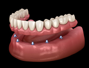 Mandibular removable prosthesis All on 6 system supported by implants.  Medically accurate 3D illustration of human teeth and dentures concept