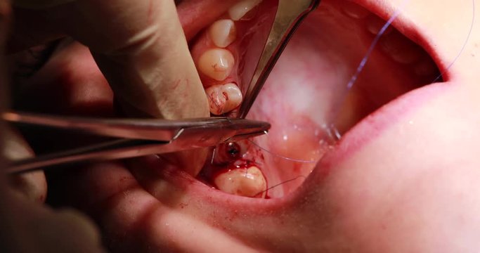 The mouth implants the tooth . Dental implant procedure . How do dental implants work graphic representation from dental implant placement to completing the tooth.