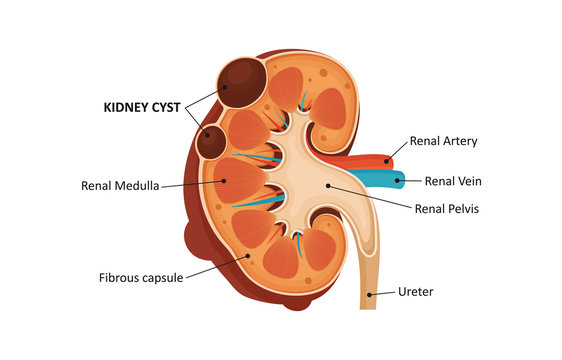 Kidney cyst. Vector illustrations
