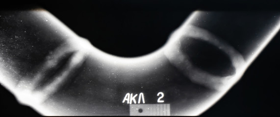 X-ray of a welded seam of the pipeline