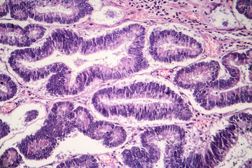Histopathology of intestinal adenoma, light micrograph, photo under microscope