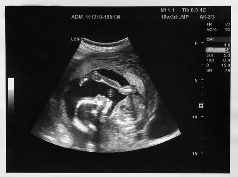 Ultrasound with pregnancy Obstetric of fetus Medical images. pregnant mother.