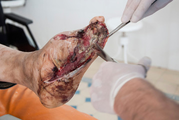 Foot wound becomes infected. Phlegmon of the foot. Purulent wound of the foot. Foot surgery....