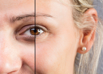 Comparison before and after dark circles under eye correction