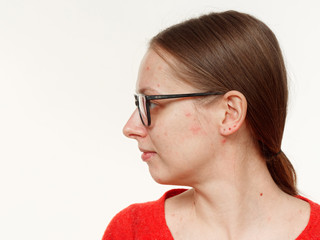 portrait of a girl without makeup. acne on the face. on a white background