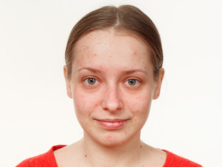 portrait of a girl without makeup. acne on the face. on a white background - 250817343