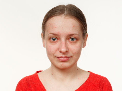 portrait of a girl without makeup. acne on the face. on a white background