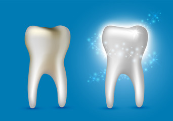 Beautiful realistic dentist vector set of decayed and white shiny cleansed tooth on blue background.