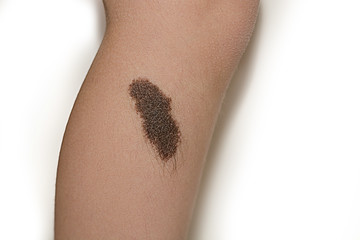birthmark nevus