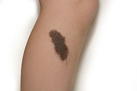 birthmark nevus