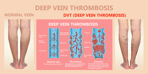 Deep Vein Thrombosis or Blood Clots. Embolus.