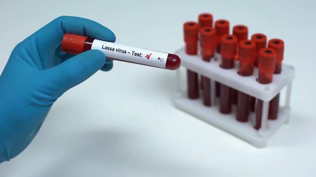Negative Lassa virus test, doctor showing blood sample, lab research, healthcare