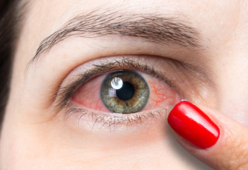 Brown and grey eye of girl close up suffering from redness