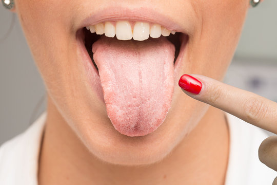 Woman having candidiasis pointing her tongue with finger