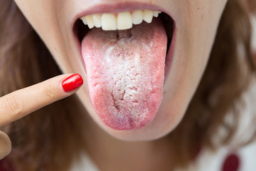 Woman with halitosis for candida albicans pointing her tongue with finger