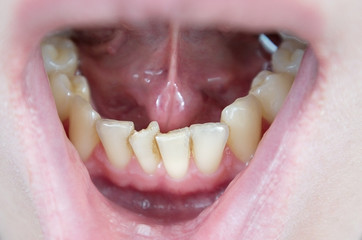crooked teeth on the lower jaw, crowding of teeth in the anterior part, crowded incisors