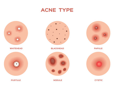 Acne and Pimples, stages of development, graphic vector