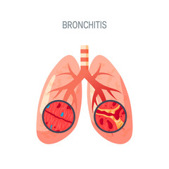 Bronchitis disease vector icon in flat style