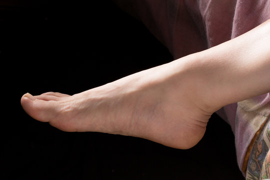 Female foot suffering from flat-foot condition