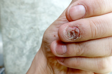Close up of fungus nail infection. Fungal infection on nails hand, finger with onychomycosis, damage on human hand on gray concrete wall background. Disease and Symptom concept.