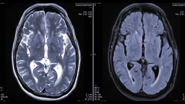 MRI brain or magnetic resonance imaging in axial view comparison T1 vs T2  showing anatomical of the brain.